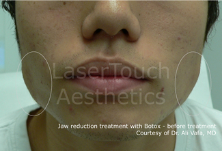 jaw reduction before brooklyn park slope